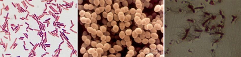 Escherichia Coli, Fecal Enterococcus and Proteus are the main causes of chronic bacterial prostatitis