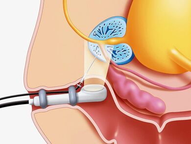 Prostate Biopsy needle
