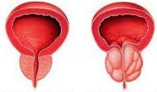 A healthy prostate and inflamed